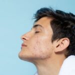 What To Do With This Acne?!