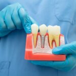 Root Canal Treatment: What You Need to Know Before You Make An Appointment