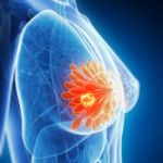Male Breast Reduction: Understanding Gynecomastia Surgery