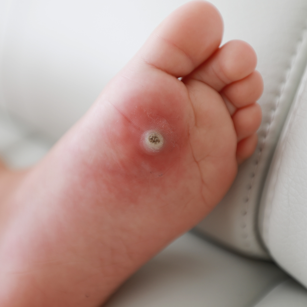 Warts