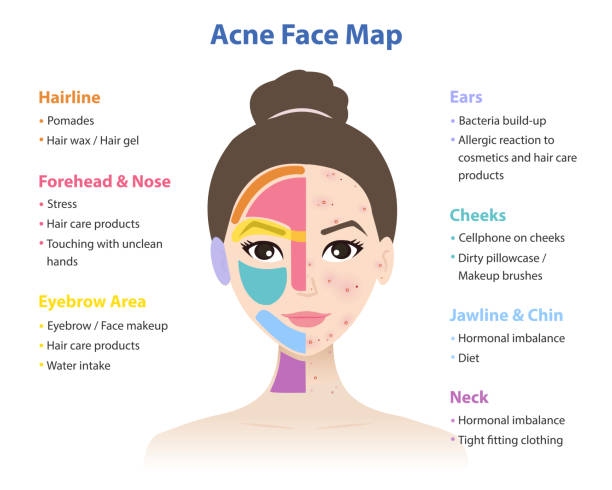 Face Mapping: What Your Breakouts Are Trying to Tell You